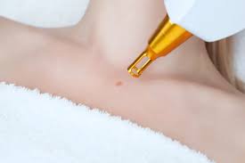 skin tag removal torrance ca