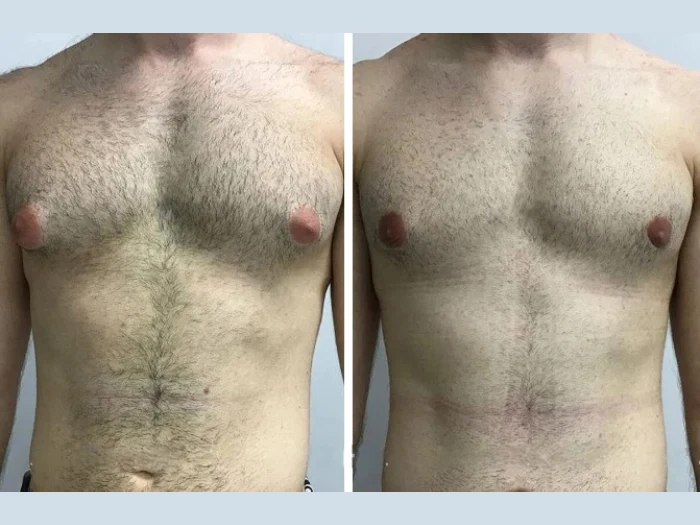 Why Athletes Prefer the Best Gynecomastia Surgeons in Dubai