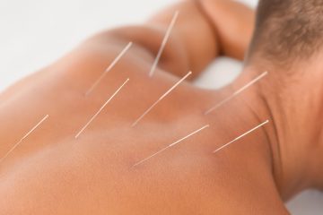 Acupuncture
