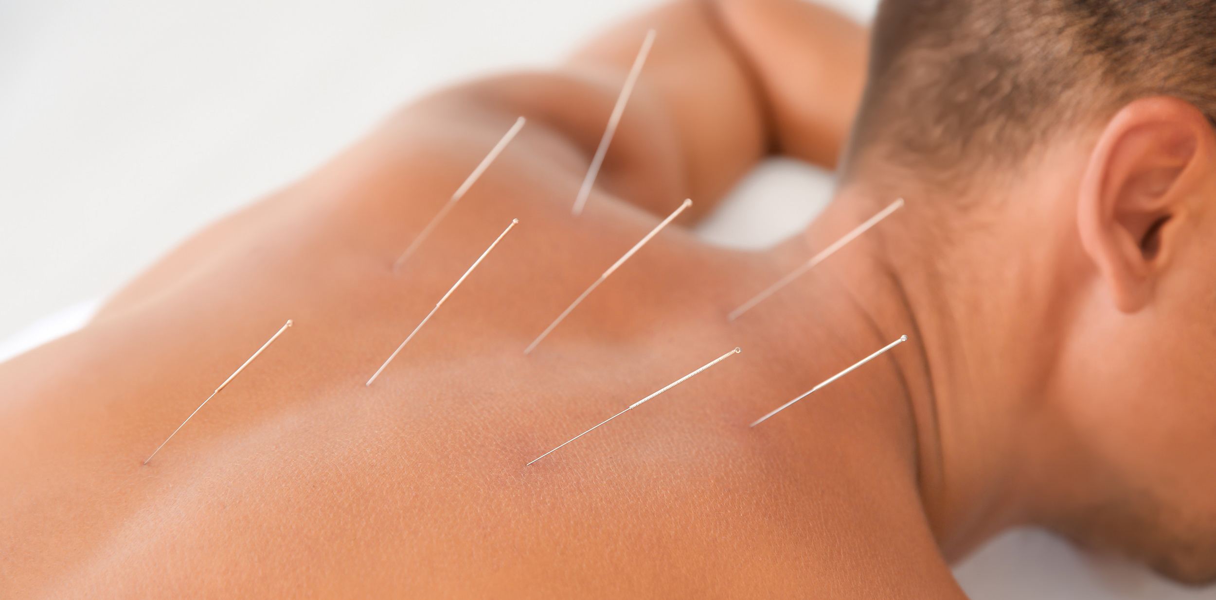 Acupuncture