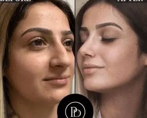 PRP Treatment in Dubai for Postpartum Hair Loss Recovery
