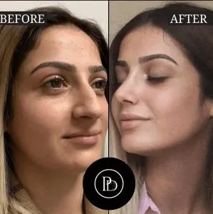 PRP Treatment in Dubai for Postpartum Hair Loss Recovery