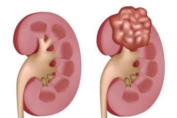 Urologist in Jaipur | Specialized Kidney Cancer Treatment in Jaipur