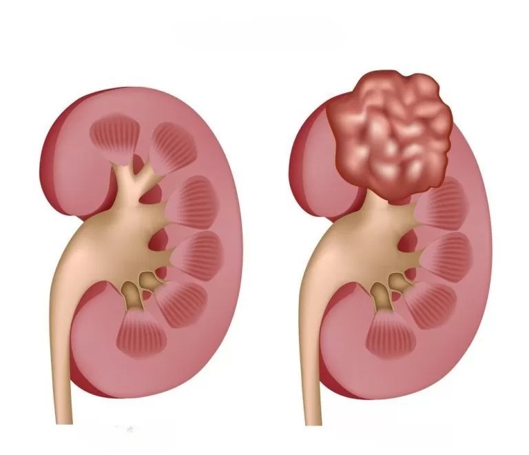 Urologist in Jaipur | Specialized Kidney Cancer Treatment in Jaipur
