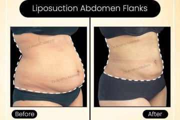 liposuction cost in Dubai