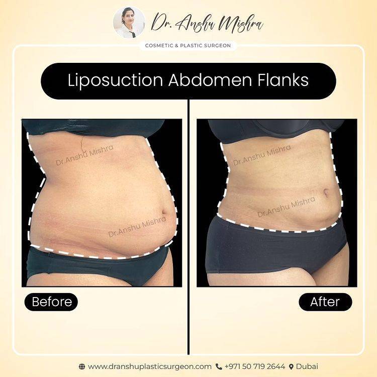 liposuction cost in Dubai