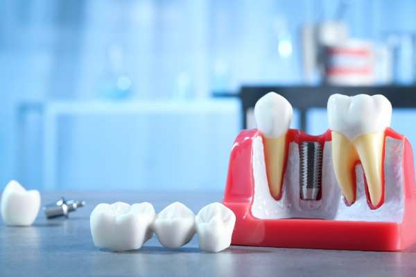 Dental Implants