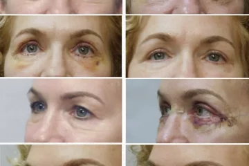 Plastic Surgery Recovery Nurse for After Care: