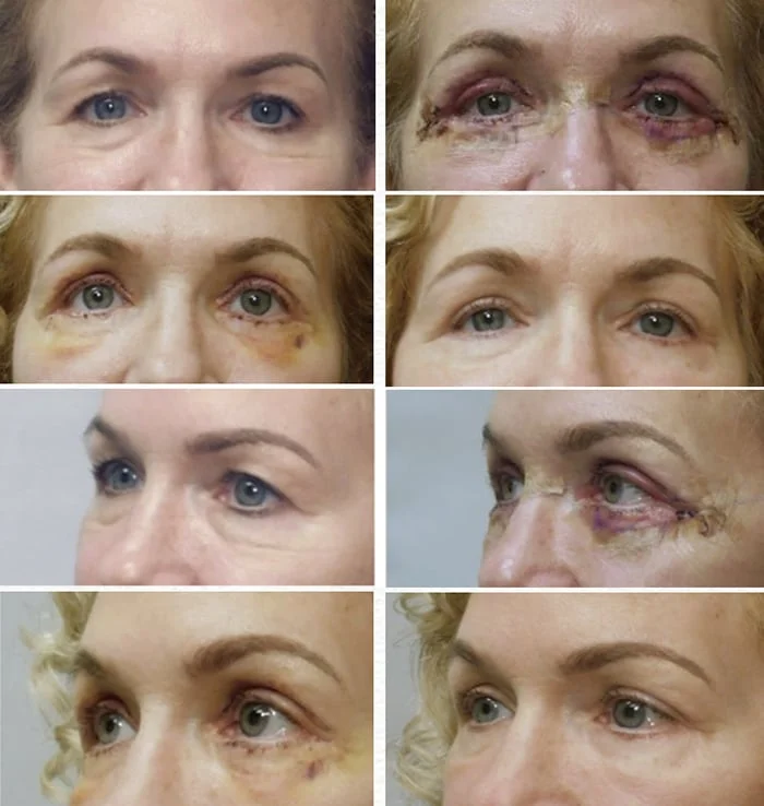 Plastic Surgery Recovery Nurse for After Care: