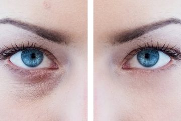 surgery for eye bags