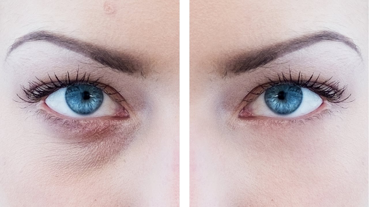 surgery for eye bags