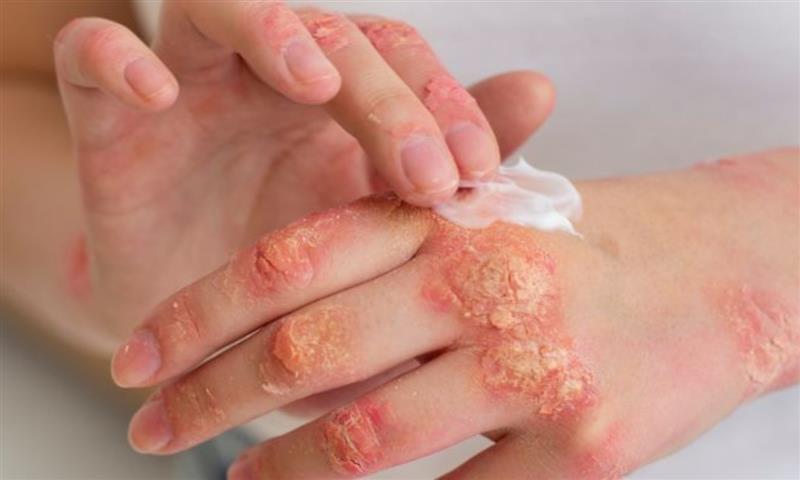 fungal infection specialist in surat